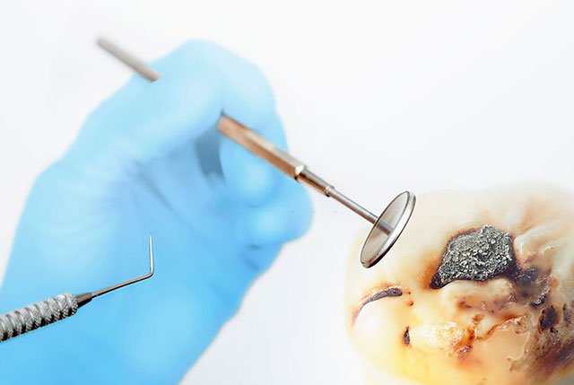 How to Get Food Out of Wisdom Tooth Hole